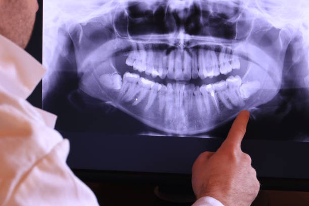 Best Knocked-Out Tooth (Avulsed Tooth) Treatment in Fairmont, NC