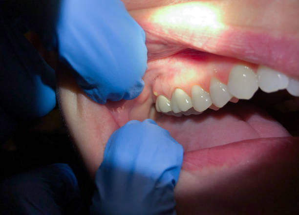 Best Emergency Denture Repair in Fairmont, NC